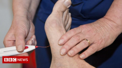 Worry over high rates of diabetes foot amputations