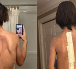 ‘They wear’t care about me, mother’: Teen’s scoliosis surgicaltreatment postponed 5 times