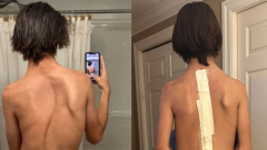 ‘They wear’t care about me, mother’: Teen’s scoliosis surgicaltreatment postponed 5 times