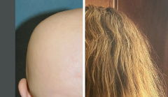 A brand-new treatment for alopecia location is safe for teenagers
