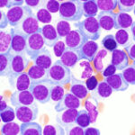 A drug might enhance stem cell transplant for several myeloma clients