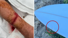 West Australian internetuser Max Marsden goesthrough surgicaltreatment after being assaulted by shark
