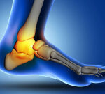 Advancement: Scientists determined the degree to which a bone fracture can lead to early death