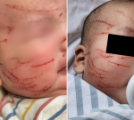 Infant terribly scratched at Only About Children Melbourne Central childcare centre