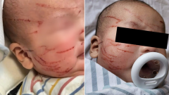 Infant terribly scratched at Only About Children Melbourne Central childcare centre