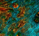 Skin cells work together to battle cancer
