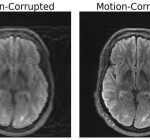Integrating deep knowing and physics to repair motion-corrupted MRI scans