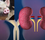 Pig kidney transplants into a human offer a life-sustaining function for the veryfirst time