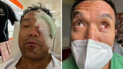 Melbourne guy’s message for other hurt employees after losing eye in dreadful office mishap