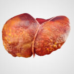 Hormonalagents have the possible to reward liver fibrosis