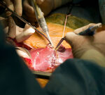 Mahvash Disease Case Resolved With Liver Transplantation