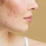 Grownup Acne: Causes, Treatment, and Prevention Tips