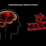 Brain hemorrhage treatment enhances survival possibilities