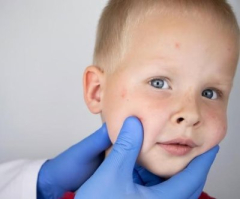 Florida cosmeticsurgeon basic postpones to momsanddads over CDC throughout measles breakout
