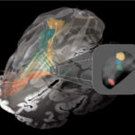 Utilizing deep brain stimulation, scientists determine disrupted neural circuit