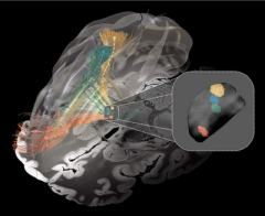 Utilizing deep brain stimulation, scientists determine disrupted neural circuit