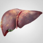 Pioneering technique to takeon deadly liver cancer