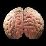 Larger human brains deal a protective impact versus dementia