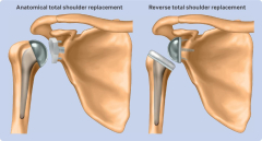 Insights into shoulder replacement choices for Osteoarthritis: A brand-new researchstudy