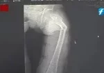 35-Year-Old Man Breaks Hardest Bone in the Human Body While Coughing