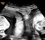 Lady with uncommon double uterus provides birth to twins