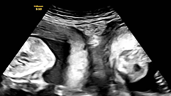 Lady with uncommon double uterus provides birth to twins