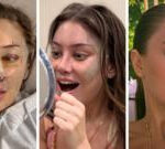 A facelift at 28? Why young people are turning to plastic surgery