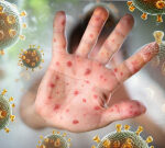 Measles alert issued for Gold Coast school and bus routes after confirmed case